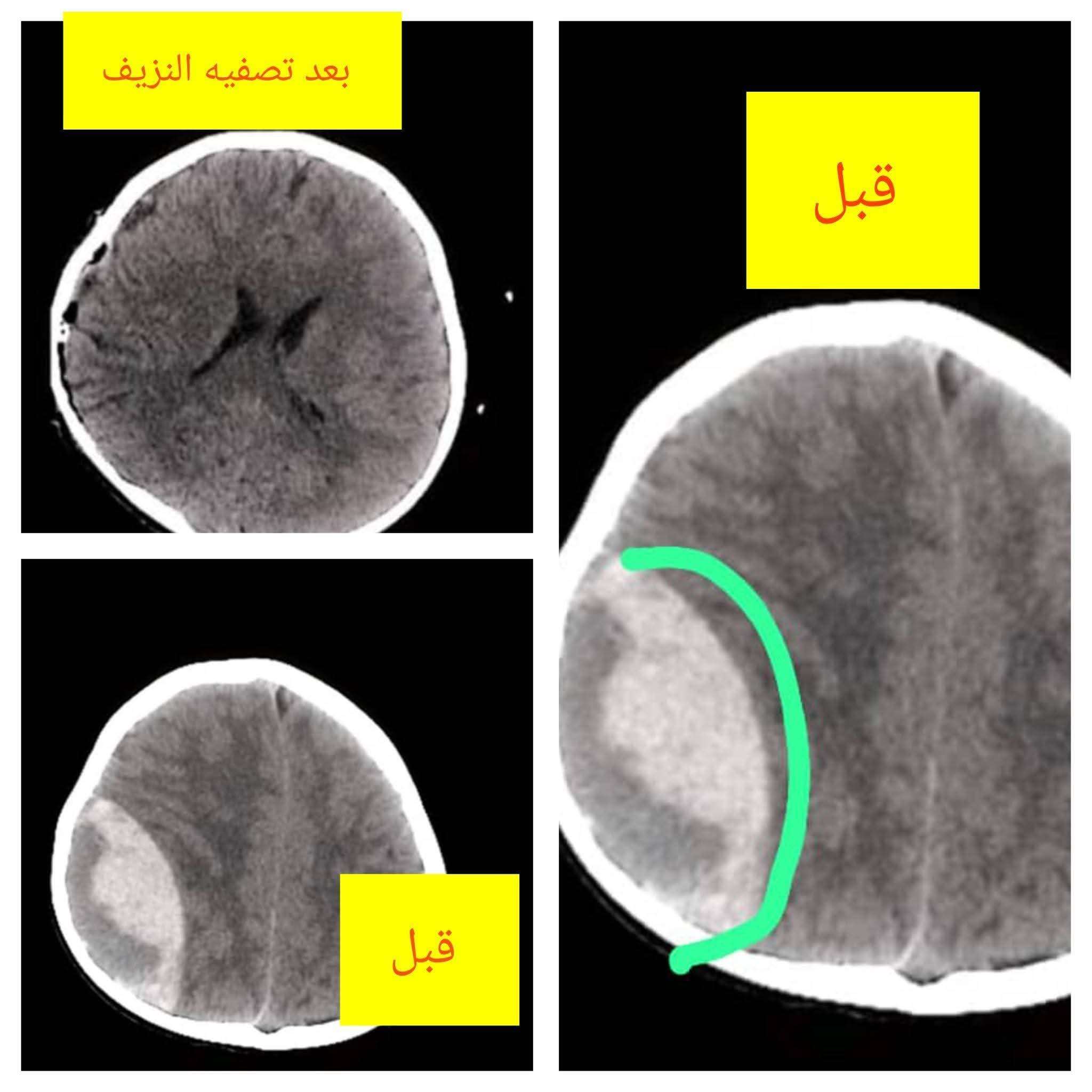 إنجاز طبي نوعي في جراحة المخ والأعصاب بمستشفى الشهيد الدفيعة بيحان ينقذ حياة طفل.
